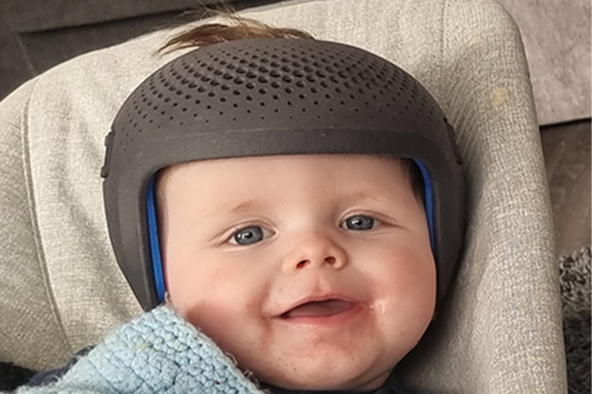 Conditions Plagiocephaly